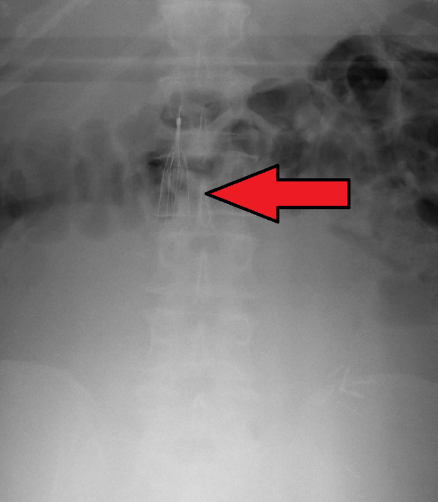 Society of Interventional Radiology Reveals IVC Filter Clinical ...